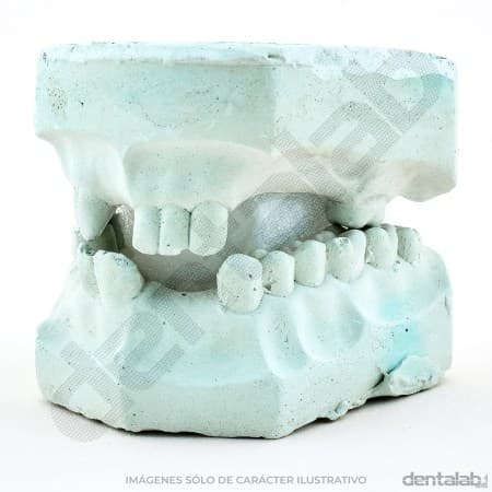 Modelo de Yeso Parcialmente Dentado x Par