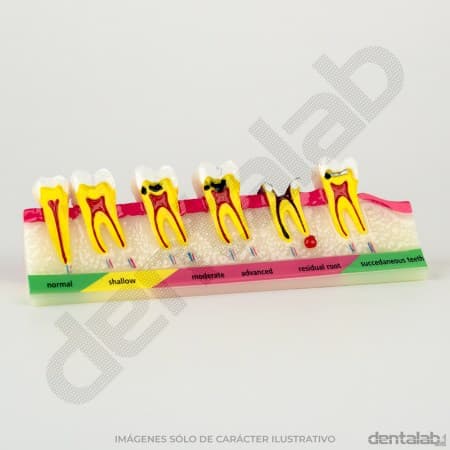 Modelo Progresión de Caries