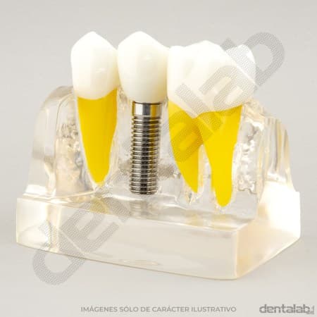 Macromodelo Acrílico Fijo 3 piezas (con Implante)