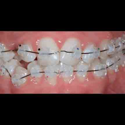 BRACKETS C.D. ESTÉTICOS STEP SYSTEM 2.0 COPOLIMERO DE MICRO-RELLENO (.022″x.030″)/KIT INTRODUCCIÓN STEP 2.0 & SLIDE