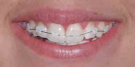 BRACKETS C.D. ESTÉTICOS STEP SYSTEM 2.0 DE CERÁMICA (.022″x.030″)/KIT INTRODUCCIÓN STEP 2.0 & SLIDE