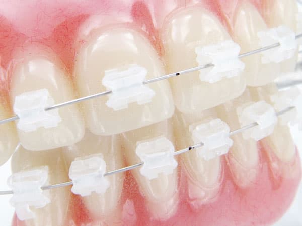 ARCOS MEMORIA NI TI ZAFIRO-ESTÉTICOS REDONDOS/CUADRADOS – SUPERIORES E INFERIORES