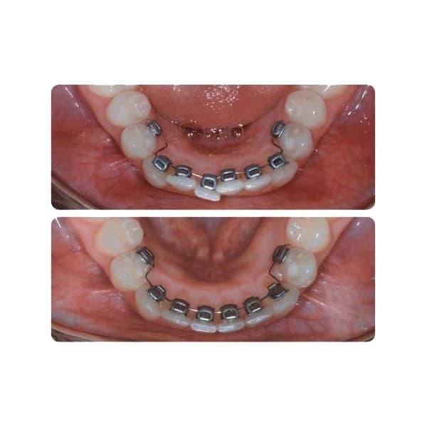 BRACKETS LINGUALES IDEA-L/KIT BRACKETS LINGUALES IDEA-L