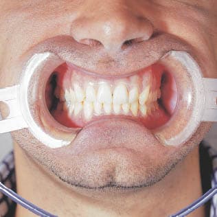 SEPARADOR/KIT SEPARADOR