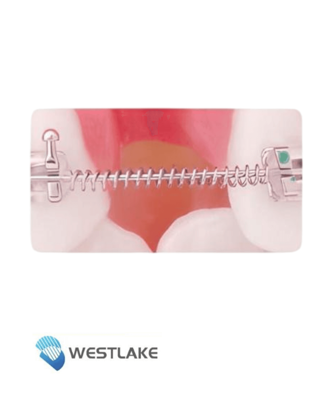 Resorte Abierto  0.010 Paquete x 2 U- Westlake